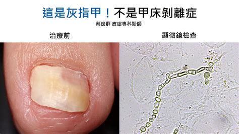 指甲分開|非傳染性皮膚疾病：